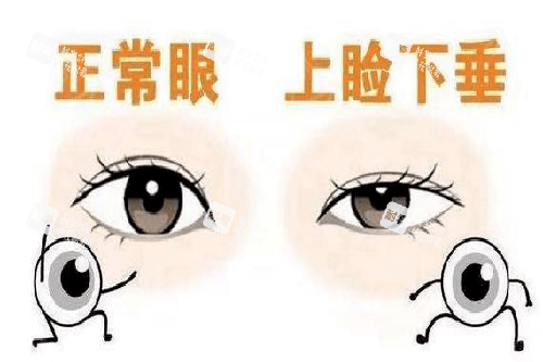 正常眼和眼睑下垂对比