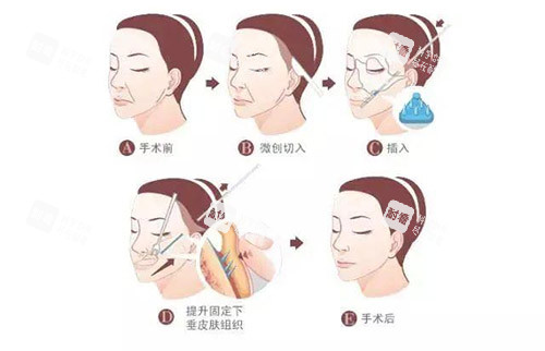 安多泰拉皮手术