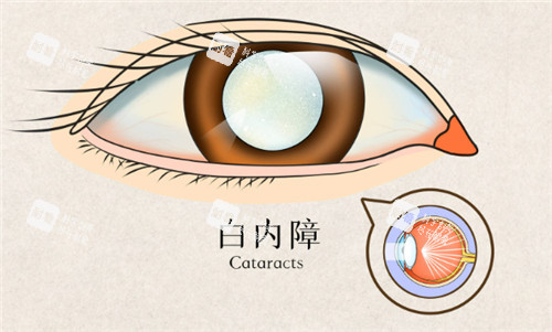 白内障眼睛表现
