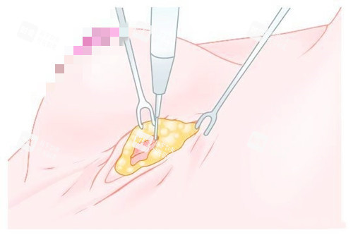 乳房下皱襞切口