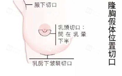 乳房下皱襞切口图