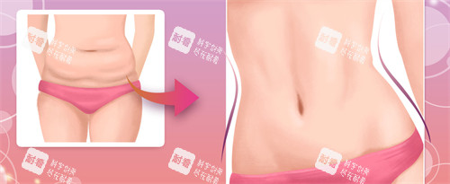 腹壁成形手术前后对比图