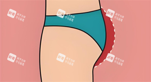 臀部提升区域