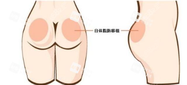 臀部塑形手术