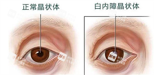 正常晶状体和白内障晶状体