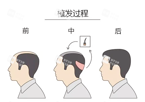 植发过程图示