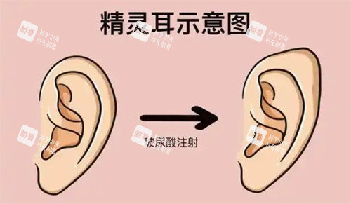 精灵耳注射