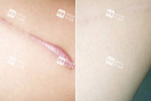 增生疤痕修复对比图