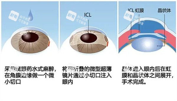 icl晶体植入手术方法