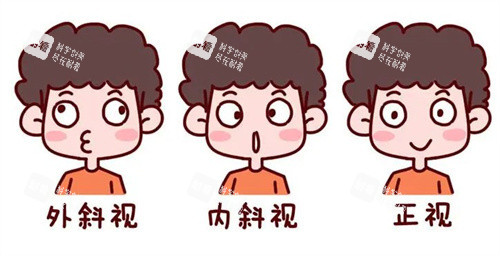 斜视的种类
