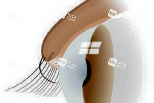 上眼皮倒睫示意图