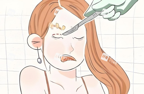 割眼角漫画示意图