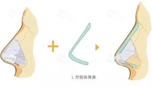 L型假体隆鼻步骤示意图
