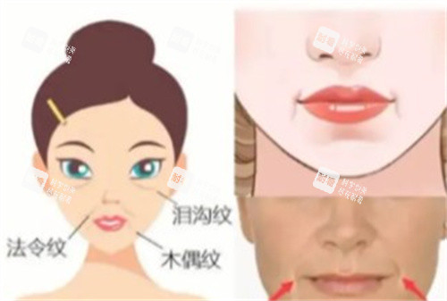 微拉美手术改善