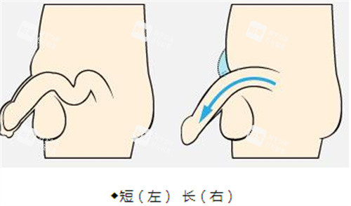 阴茎增长手术前后演示动画图