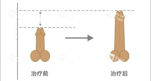 阴茎增长手术前后长度对比动画图