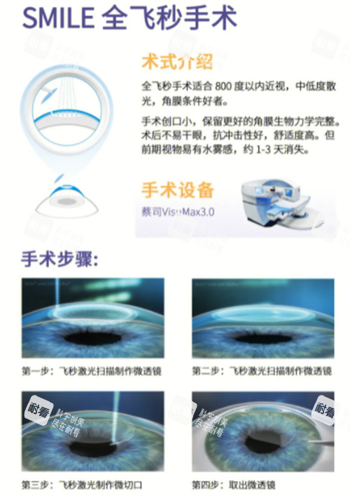 全飞秒近视手术术式介绍图解