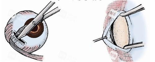 斜视下斜肌手术