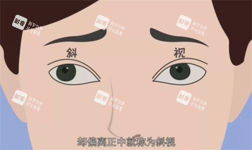 斜视的样子