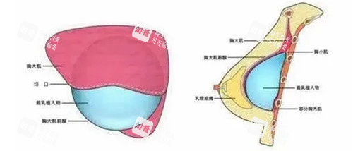 假体隆胸胸部切口卡通示意图