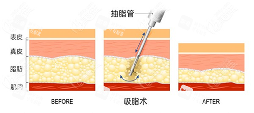吸脂手术方法