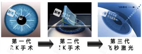 近视手术的进阶过程