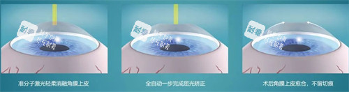 近视手术简要流程