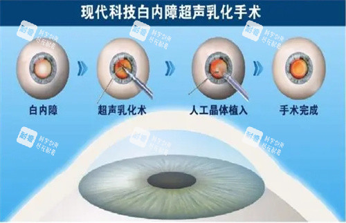 白内障眼科手术过程