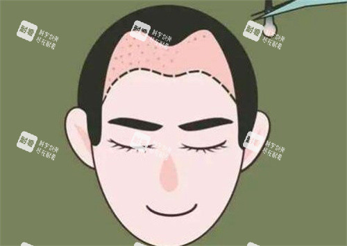 M型发际线种植