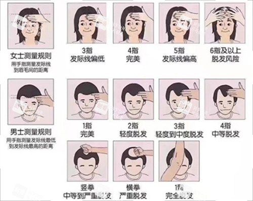 发际线测量规范