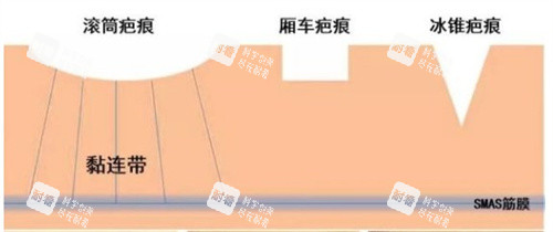 不同的疤痕种类