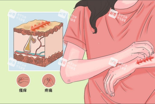疤痕增生引起的症状示意图