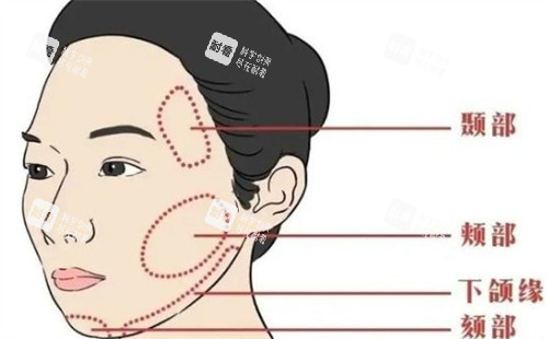 面部提升可以提升的区域