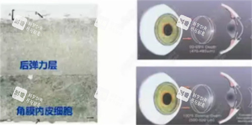 角膜移植术手术过程