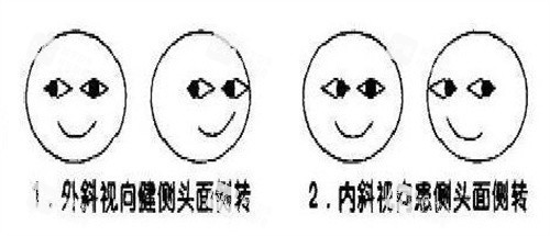 斜视自测图