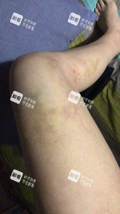 大腿吸脂术后淤青