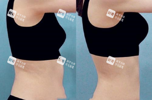 腰腹部吸脂手术前后对比图