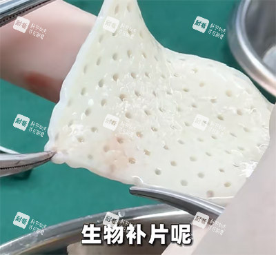 生物补片改善增大增粗照片