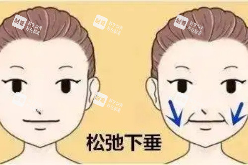 嘴角松弛下垂对比图
