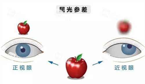屈光参差