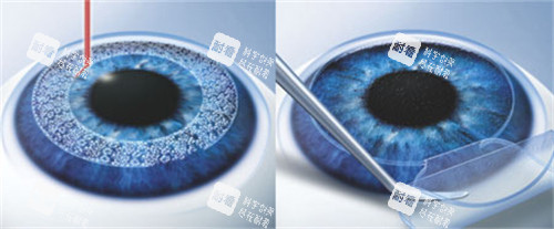 成都双楠医院眼科好不好,做近视眼手术很出色备受顾客好评!
