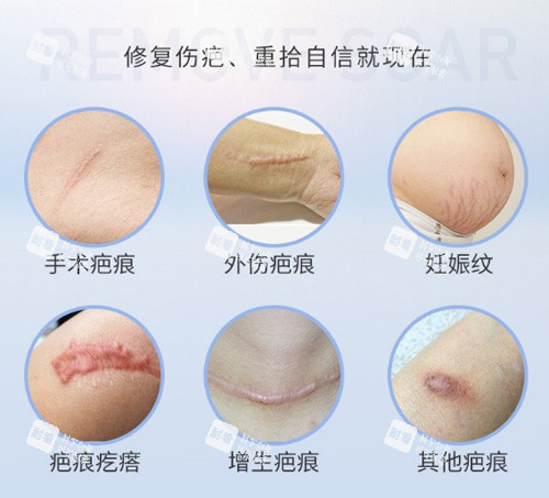 不同疤痕图片 不同疤痕图片