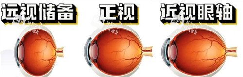 不同眼睛问题的眼轴不同
