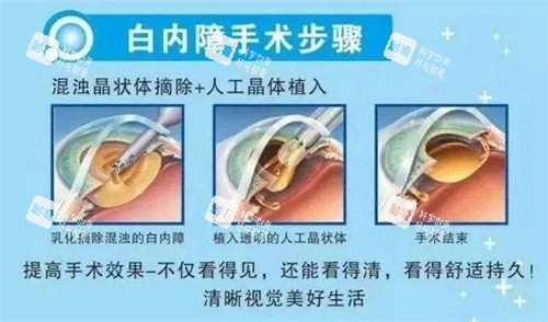 白内障手术示意图