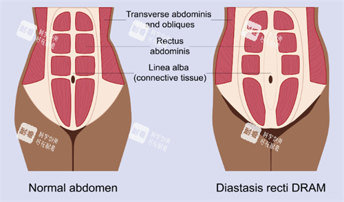 腹壁成形改善肌肉 腹壁成形改善肌肉