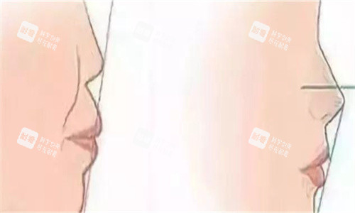 隆鼻前后侧面对比