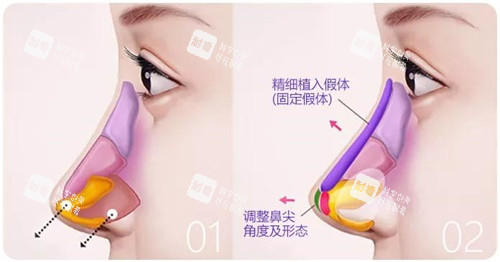 鼻综合示意图