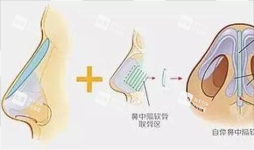 鼻小柱延长手术部位细节动画展示