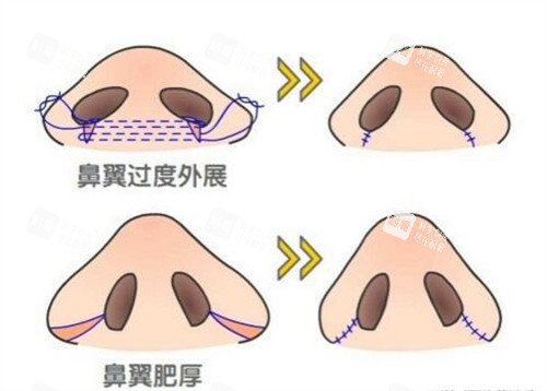 鼻翼缩小手术对比