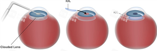 人工晶体植入的层次